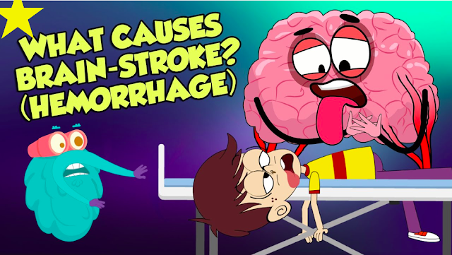 What Causes A Brain Stroke
